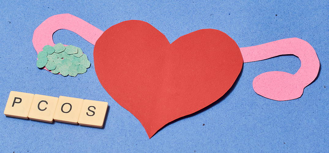 Polycystic Ovarian Syndrome (PCOS):<br>What you need to know